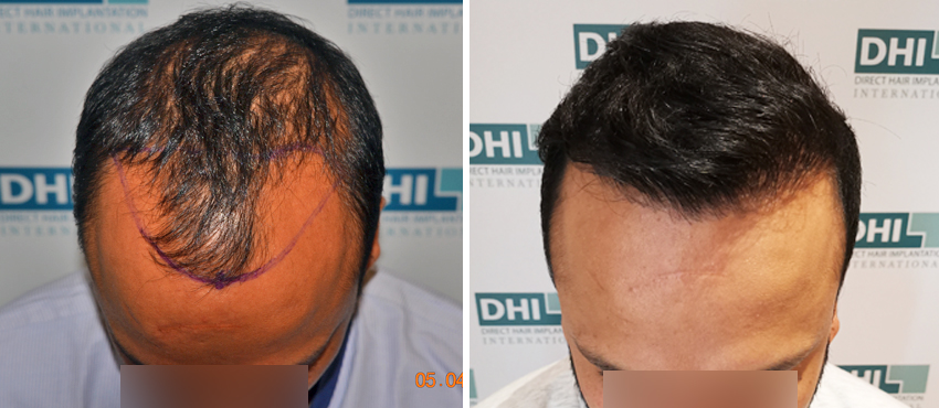 DHI before & after hair transplant results